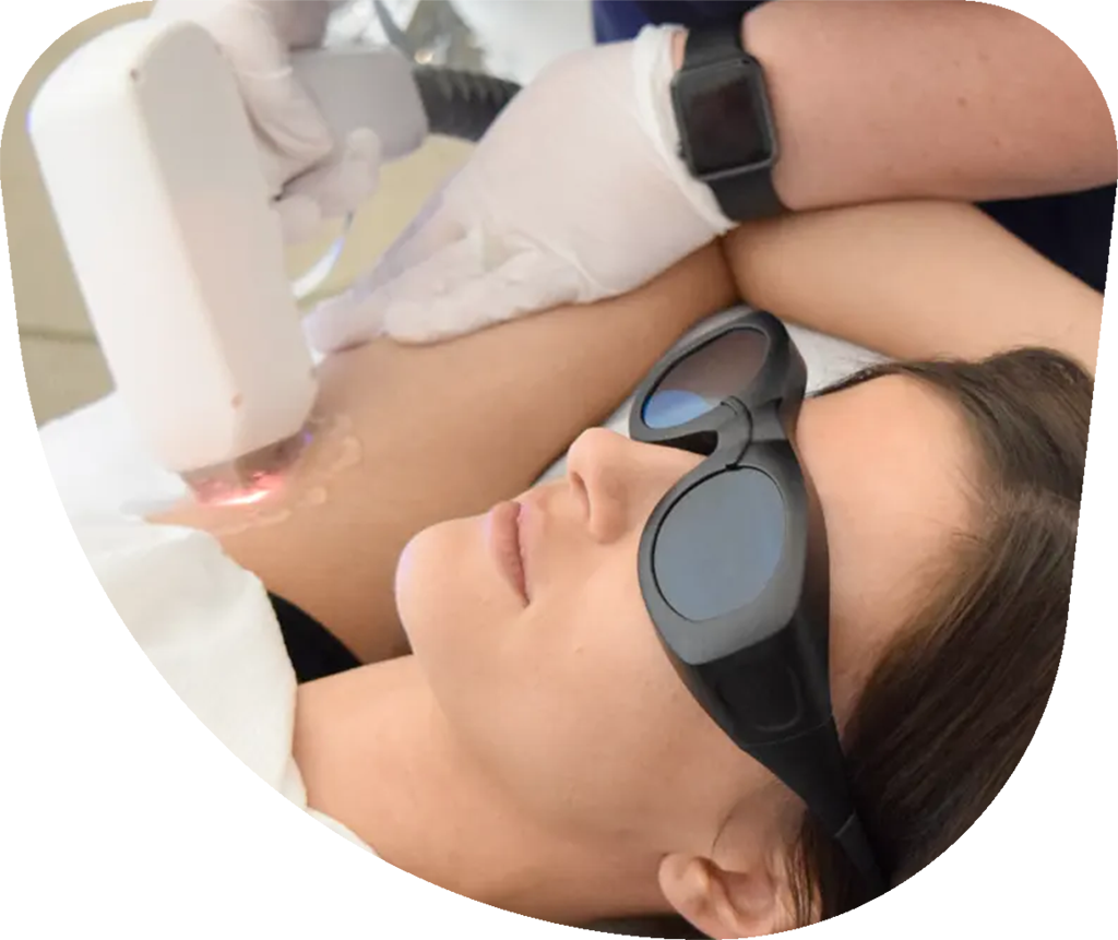 Laser hair removal treatment